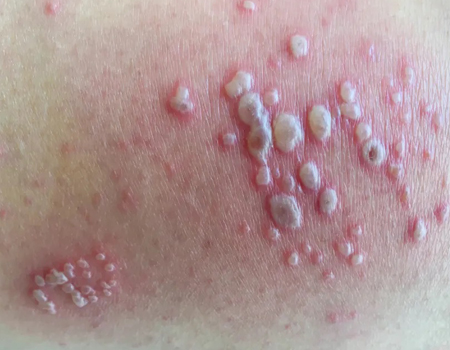Skin-Allergy